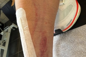 慎入！前德甲球员霍尔特比荷甲遭遇凶狠犯规，脚被划开一道口子